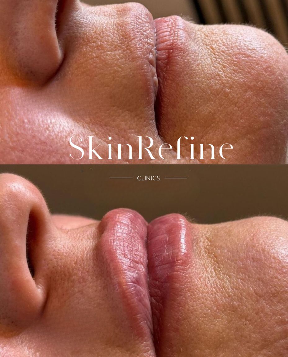 Voor en na resultaat 0,5ml Belotero lip filler door Siawash bij Skin Refine Clinics Utrecht