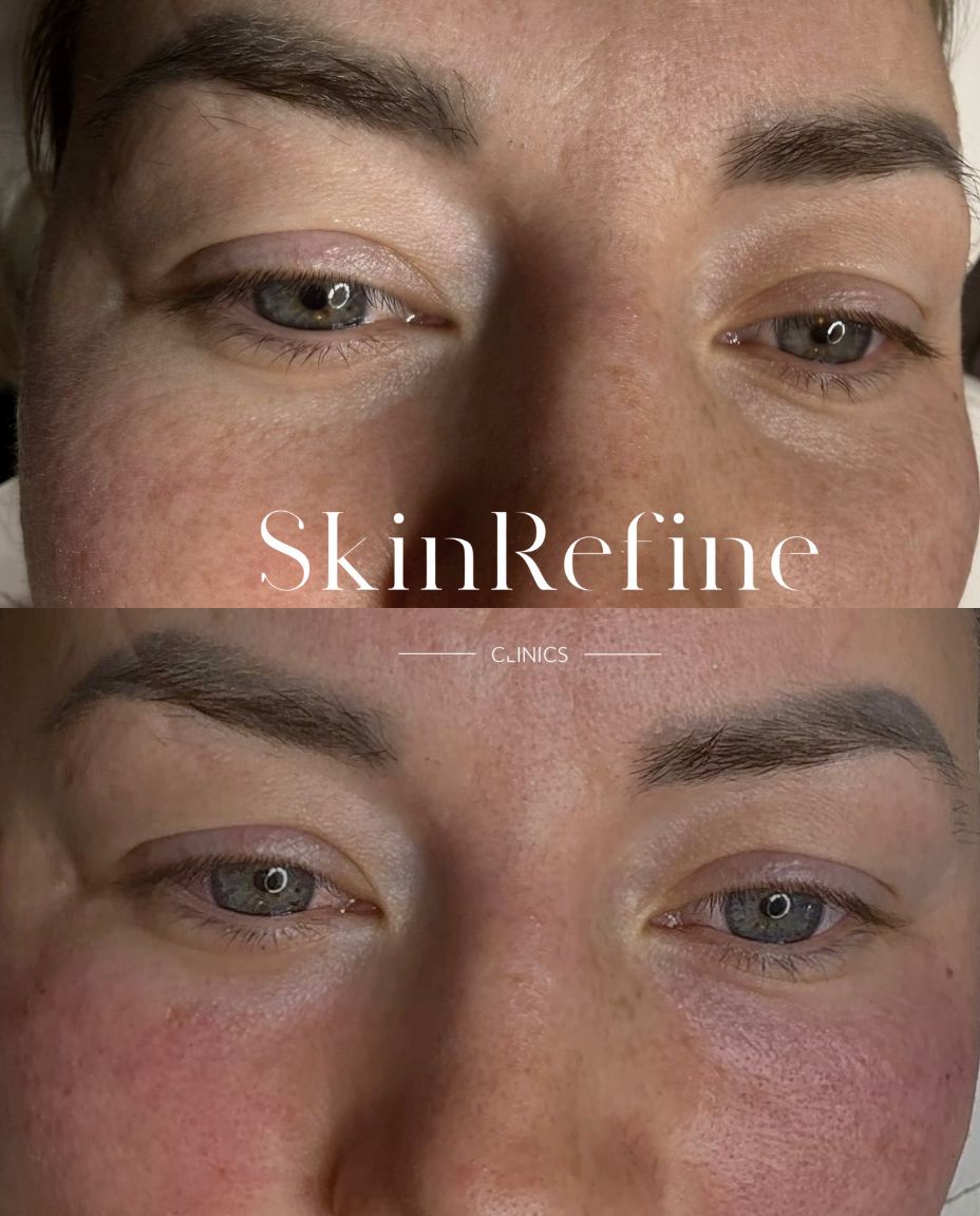 Voor en na resultaat traangootbehandeling filler door Siawash bij Skin Refine Clinics Utrecht