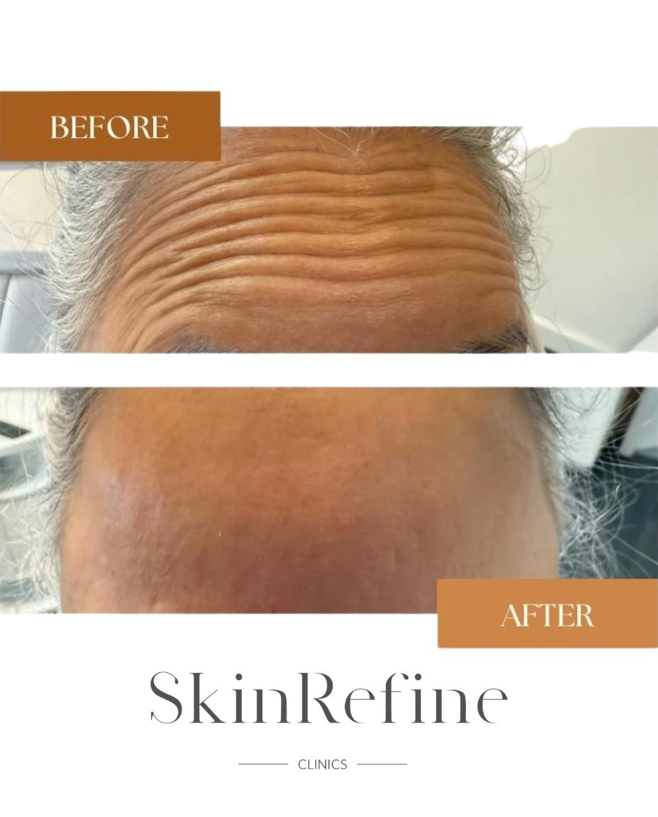 Voor en na resultaat botox voorhoofd rimpels door Siawash bij Skin Refine Clinics Utrecht